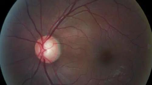 青光眼的克星来袭，助力患者远离视力的“窃贼”